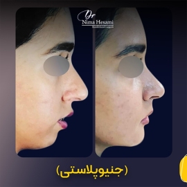 جراحی-زیبایی-چانه-1