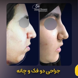 جراحی-زیبایی-چانه-2