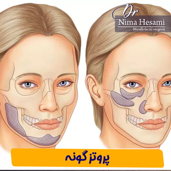 پروتز گونه - دکتر نیما حسامی