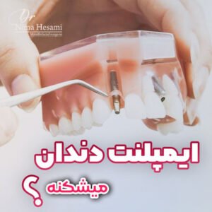 ایمپلنت دندان در تهران - دکتر نیما حسامی