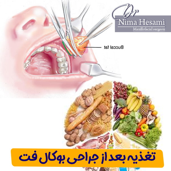 تغذیه بعد از جراحی بوکال فت - دکتر نیما حسامی