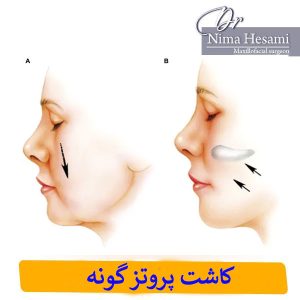 عمل پروتز گونه در تهران _ دکتر نیما حسامی