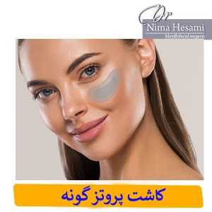 جراحی پروتز گونه در تهران _ دکتر نیما حسامی
