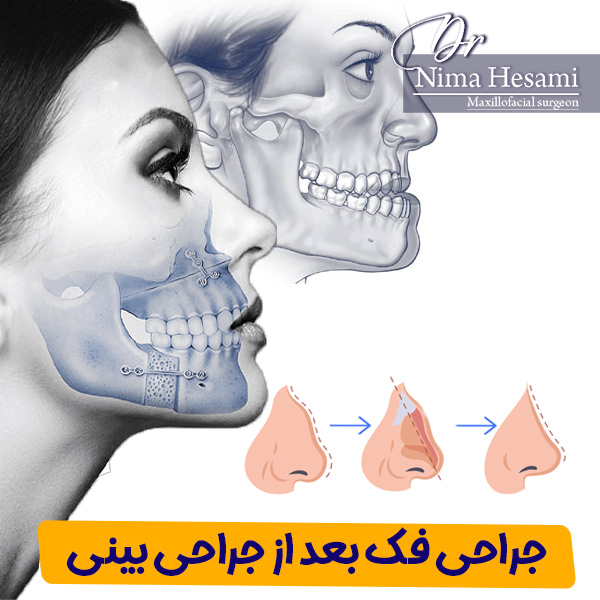 جراحی فک بعد از جراحی بینی - دکتر نیما حسامی