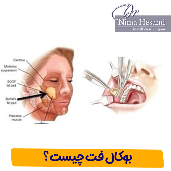 جراحی بوکال فت در تهران - دکتر نیما حسامی