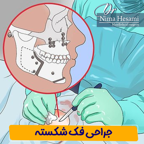 جراحی فک شکسته - دکتر نیما حسامی