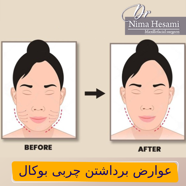 عوارض بوکال فت - دکتر نیما حسامی
