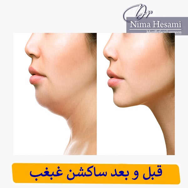 عکس قبل و بعد ساکشن غبغب _ دکتر نیما حسامی 