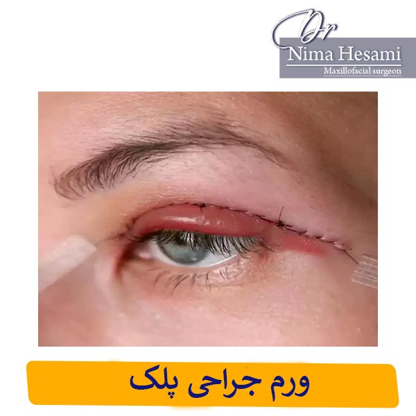 ورم جراحی پلک _ دکتر نیما حسامی