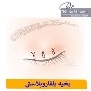 اسکار بخیه بلفاروپلاستی _ دکتر نیما حسامی